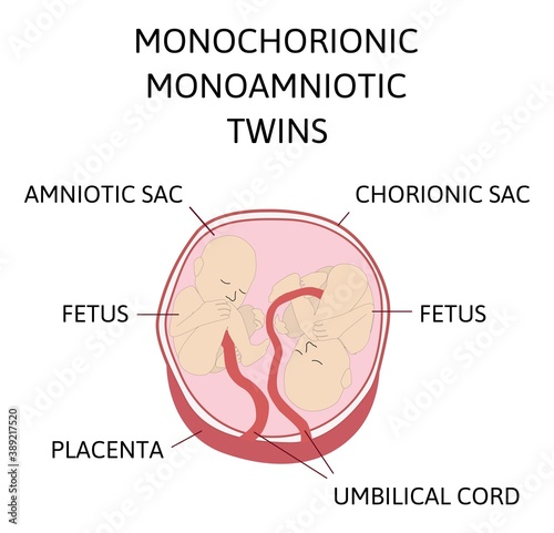Anatomy of abdomen with twins. Twin types infographic elements in flat design. Monozygotic or Dizygotic Placentation of twins medical illustration and icons isolated on white background