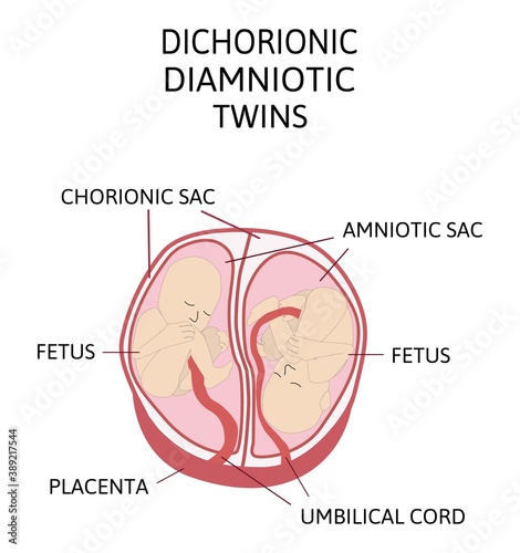 Anatomy of abdomen with twins. Twin types infographic elements in flat design. Monozygotic or Dizygotic Placentation of twins medical illustration and icons isolated on white background