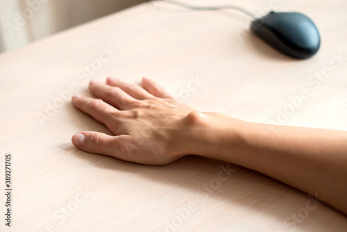 Female hand with a hygroma. Pain. Wrist ganglion cyst. Computer mouse