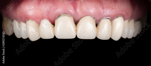 before and after picture of full mought reconstraction by crowns implants and veneers