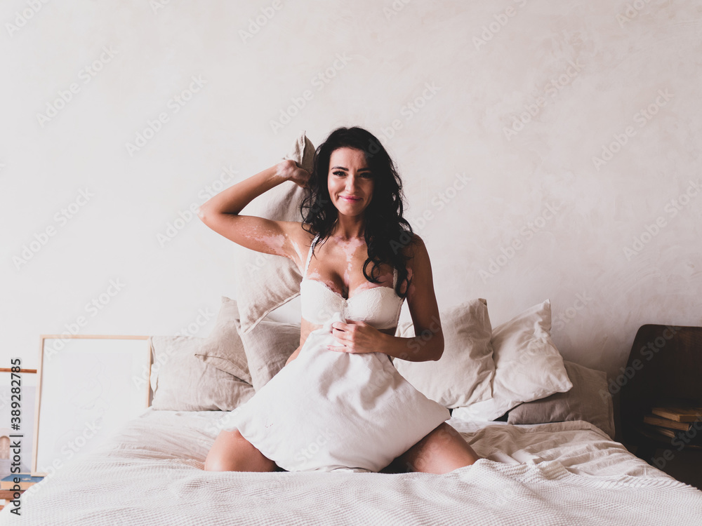 Portrait of beautiful woman in underwear with vitiligo on white bed with pillows