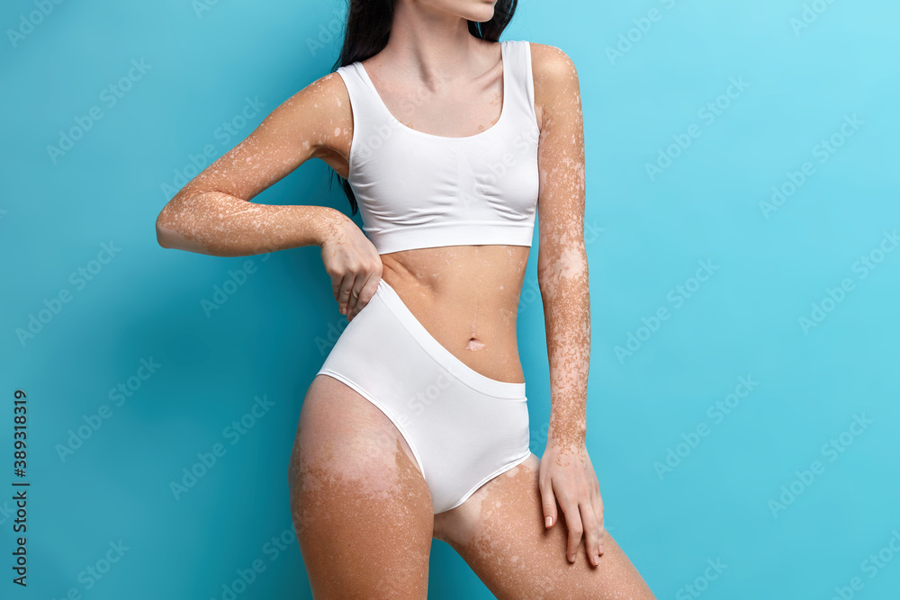 Fototapeta premium Cropped shot of fit faceless woman has perfect figure special skin with white patches dressed bra and panties poses against blue background.