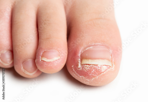 Front angle shot of a finger of a child with fungal nail infection against white background.