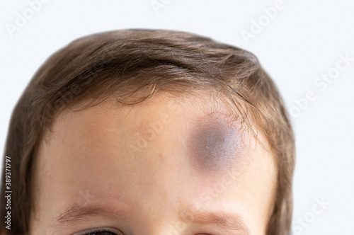 Close-up of a boy with injury on head photo