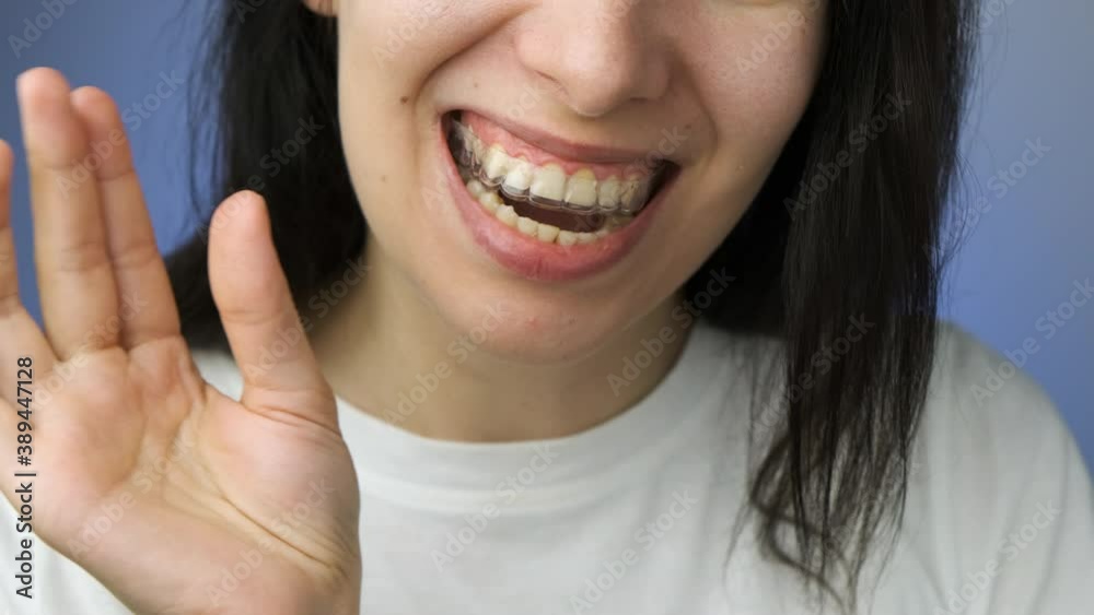 Woman easily inserts and removes invisible transparent aligner from the upper jaw Woman easily inserts and removes invisible transparent aligner from the upper jaw