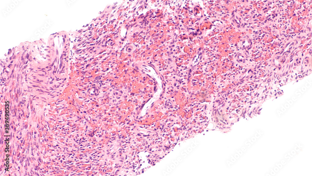 Kaposi's is a type of cancer of blood vessels caused by a virus