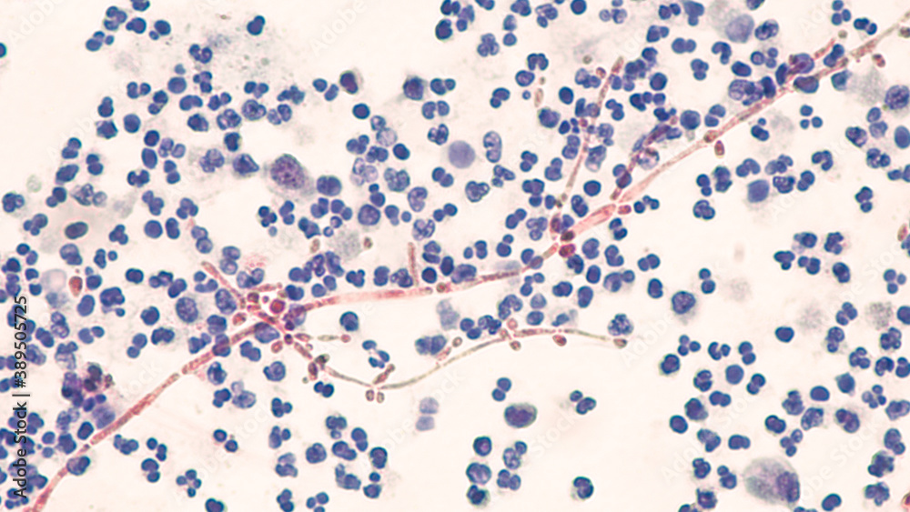 Yeast Infection; Budding yeast and pseudohyphae of Candida albicans identified in a urine cytology specimen. Pap stain. Yeast Infection; Budding yeast and pseudohyphae of Candida albicans identified in a urine cytology specimen. Pap stain.