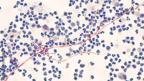 Yeast Infection; Budding yeast and pseudohyphae of Candida albicans identified in a urine cytology specimen.  Pap stain.  
