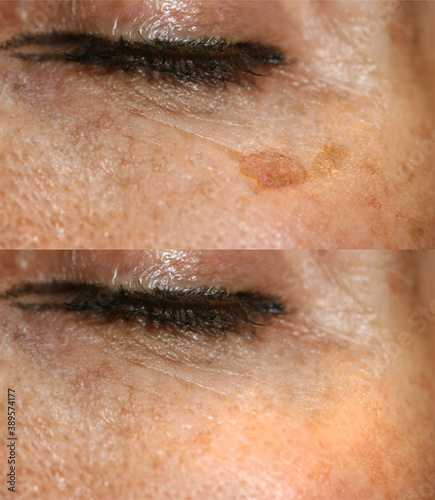 Brown spot on the skin of the face. Pigmentation on the skin. After laser removal