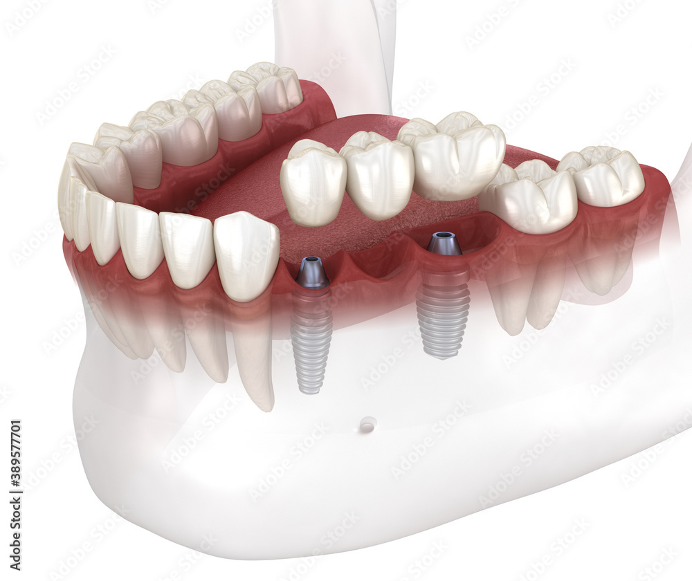Dental bridge and crown placement over implants. Dental 3D animation concept Stock Illustration | Adobe Stock Dental bridge and crown placement over implants. Dental 3D animation concept Stock Illustration | Adobe Stock