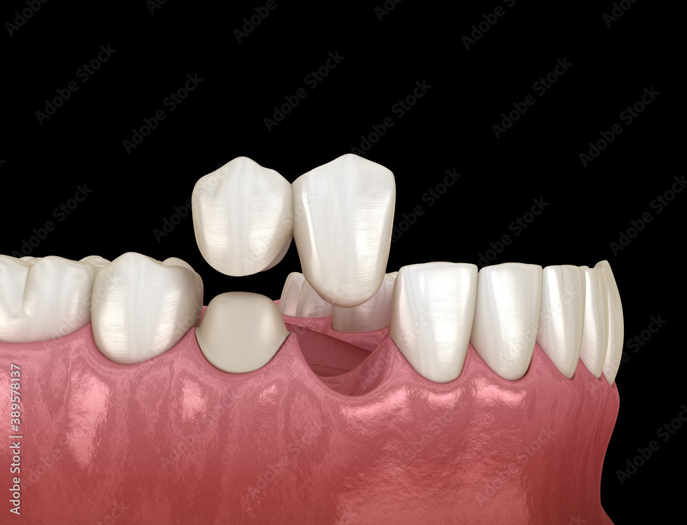 Photo Cantilever bridge made from ceramic, frontal tooth recovery, Alex ...