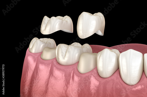 Porcelain crowns placement over premolar and molar teeth. Medically accurate 3D illustration