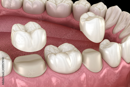 Fototapeta Naklejka Na Ścianę i Meble -  Porcelain crowns placement over premolar and molar teeth. Medically accurate 3D illustration