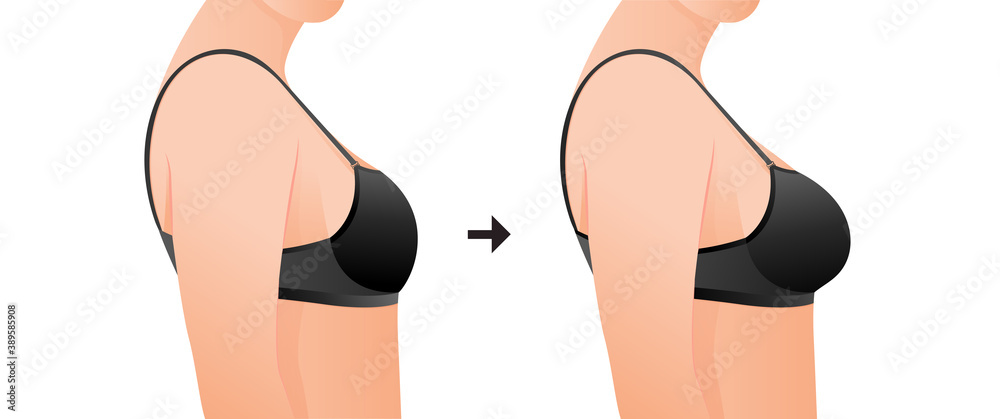 Female breasts in bra before and after augmentation/ breast size  correction. Plastic surgery concept.woman body changing from overweight to  slim as a result of training, dieting or Fitness workout. Stock Vector