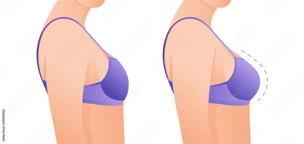 Female breasts in bra before and after augmentation/ breast size
