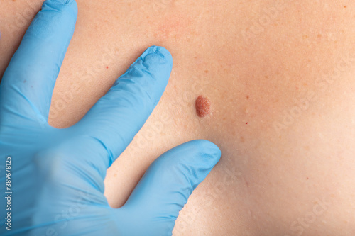 Photos Surgeon's hand in gloves inspecting skin nevus