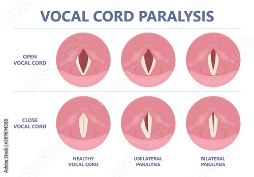 Sore loss cough virus viral acute swell sound folds treat cysts Palsy nerve Tumor botox throat hoarse larynx airway polyps Cancer injury speech
damage Ulcers box chronic nodules surgery reflux upper