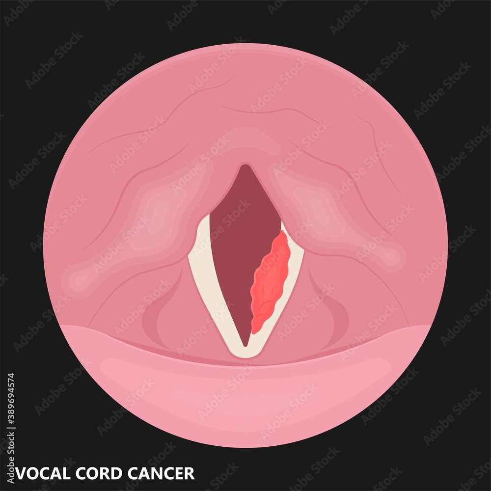 Sore loss cough virus viral acute swell sound folds treat cysts Palsy