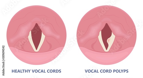 Sore loss cough virus viral acute swell sound folds treat cysts Palsy nerve Tumor botox throat hoarse larynx airway polyps Cancer injury speech
damage Ulcers box chronic nodules surgery reflux upper