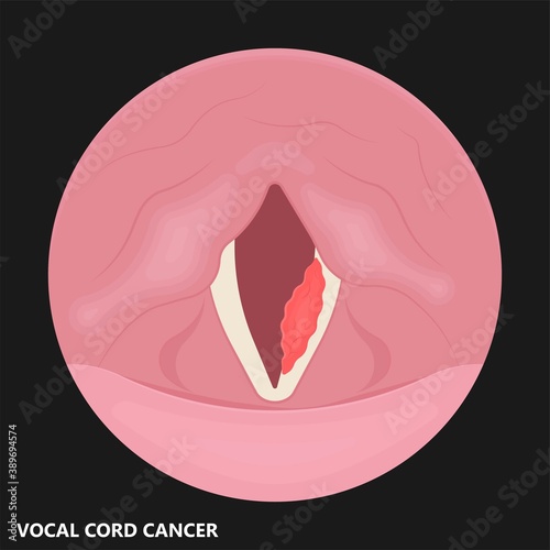 Sore loss cough virus viral acute swell sound folds treat cysts Palsy nerve Tumor botox throat hoarse larynx airway polyps Cancer injury speech
damage Ulcers box chronic nodules surgery reflux upper