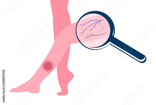 Varicose veins disease.Swelling in the legs.Problems after walking.Thrombosis disorder.Magnifying glass examines feet, large enlarged vessels.Unhealthy changes in the skin.Chronic venous insufficiency