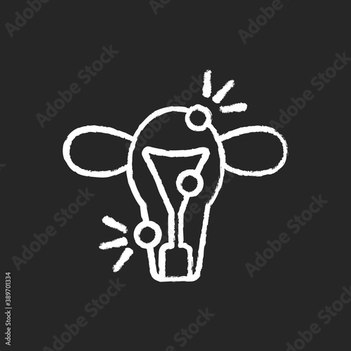 Endometriosis chalk white icon on black background. Painful disorder. Endometrium. Ovaries, fallopian tubes. Dysmenorrhea. Pelvic pain. Uterus. Isolated vector chalkboard illustration