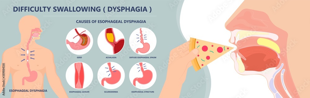 Dysphagia infection trachea examine Surgery choking gastric diagnose