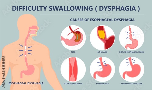 Dysphagia infection trachea examine Surgery choking gastric diagnose windpipe disorder bleeding surgical GERD treat tumor throat biopsy system ulcers stomach block eat food stuck test tract stent pain photo