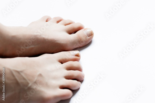 female legs on a white background.Sick nail on the foot. Toenail fungus isolated on white. Sore toenail, nail fungus close up photo.