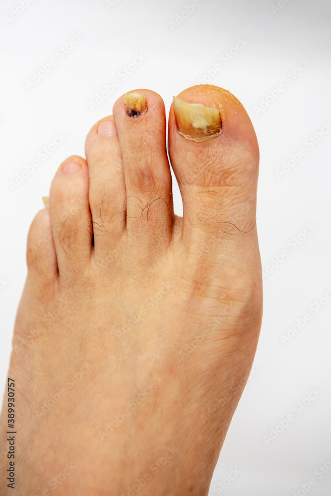 Men foot with callus on big toe and on small toes and a case of fungal