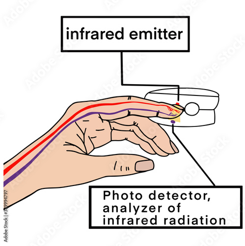 Pulse Oximeter, finger digital device to measure person's oxygen saturation. Reduced oxygenation is an emergency sign of pneumonia, for instance caused by coronavirus. . Vector illustration eps10.