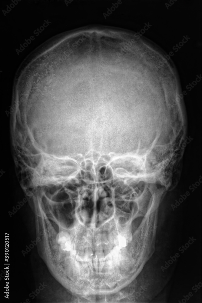 Film x-ray skull of human. Medical science concept on black background. Film x-ray skull of human. Medical science concept on black background.