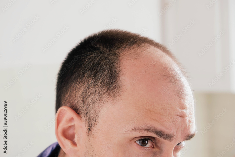 Young man looking at mirror worry about balding. Young man looking at mirror worry about balding.