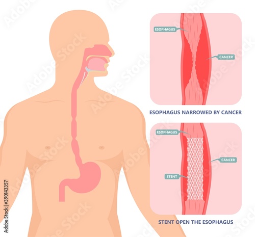 Dysphagia infection trachea examine Surgery choking gastric symptoms diagnose windpipe disorder bleeding surgical GERD treat tumor throat biopsy system ulcers stomach blocked eating food stuck test