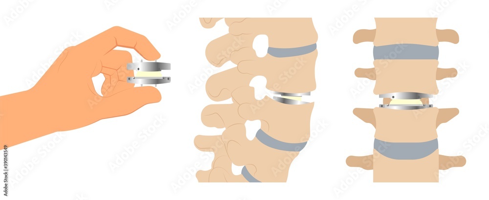 Artificial Disc for Treatment the Degenerative Disc Disease arthritis ...