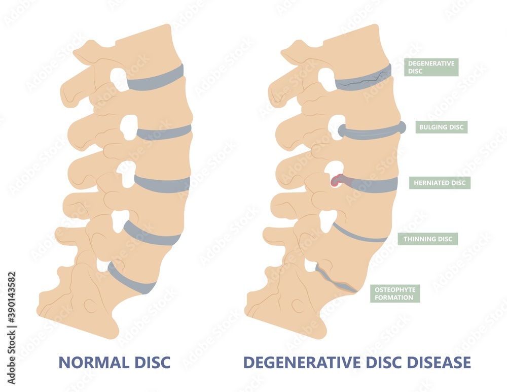 Artificial Disc for Treatment the Degenerative Disc Disease arthritis
