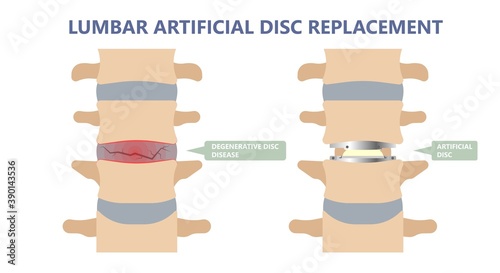 Artificial Disc for Treatment the Degenerative Disc Disease arthritis osteoarthritis spondylosis ankylosing spondylitis slipped