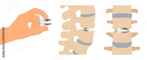Artificial Disc for Treatment the Degenerative Disc Disease arthritis osteoarthritis spondylosis ankylosing spondylitis slipped