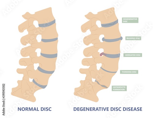 Artificial Disc for Treatment the Degenerative Disc Disease arthritis osteoarthritis spondylosis ankylosing spondylitis slipped