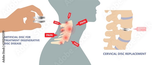 Artificial Disc for Treatment the Degenerative Disc Disease arthritis osteoarthritis spondylosis ankylosing spondylitis slipped