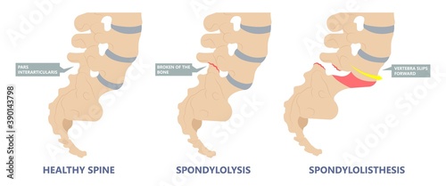 Spondylolisthesis a spinal disease that causes one of the lower vertebrae to slip forward disk hip pain bone birth defect injury sports accident exam nerve epidural steroid injections fusion leg