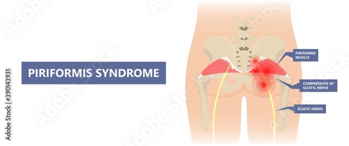 Piriformis syndrome pain and numbness in buttocks and down the back of leg