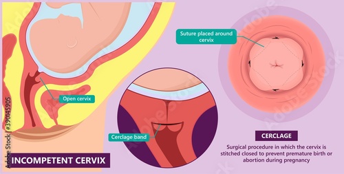 Incompetent cervix cervical insufficiency weak tissue premature stitch preterm miscarriage recurrent 