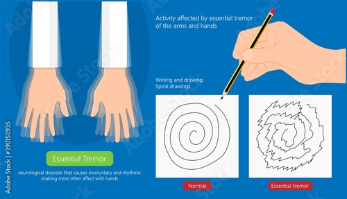 Essential tremor Deep brain stimulation DBS surgery device implant nerve uncontrollable arms head voice disability abnormal electrical controls muscle activity elderly Balance problem parkinson's