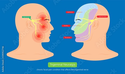 Trigeminal neuralgia chronic pain of facial TMD injury ophthalmic maxillary mandibular sensation central nervous system immune attacks myelin