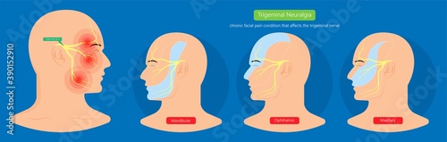 Trigeminal neuralgia chronic pain of facial TMD injury ophthalmic maxillary mandibular sensation central nervous system immune attacks myelin