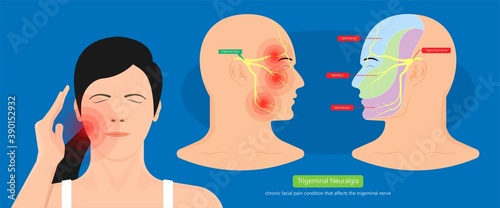 Trigeminal neuralgia chronic pain of facial TMD injury ophthalmic maxillary mandibular sensation central nervous system immune attacks myelin