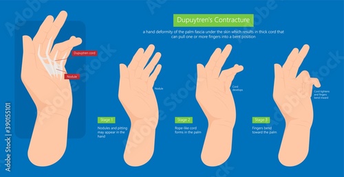 Dupuytren's contracture palm tissue disease