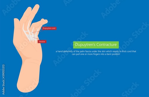 Dupuytren's contracture palm tissue disease