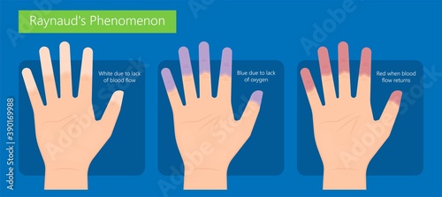 Raynaud's disease erythematosus Scleroderma buerger circulation paleness cold Injury numb vasospasm Carpal tunnel